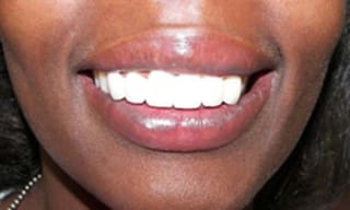 Before After Dental Case