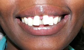 Before After Dental Case