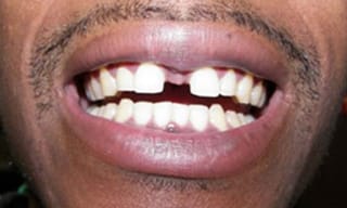 Before After Dental Case