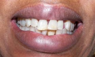 Before After Dental Case