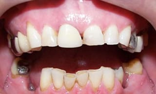 Before After Dental Case