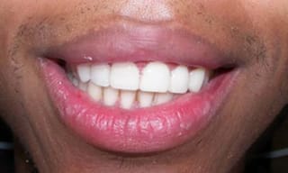 Before After Dental Case