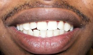 Before After Dental Case