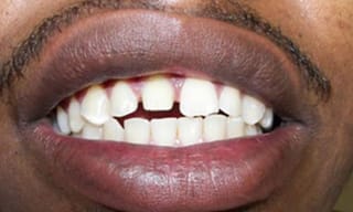 Before After Dental Case