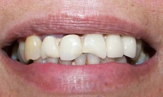 Before After Dental Case