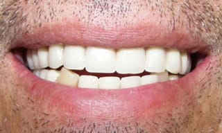 Before After Dental Case