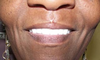 Before After Dental Case